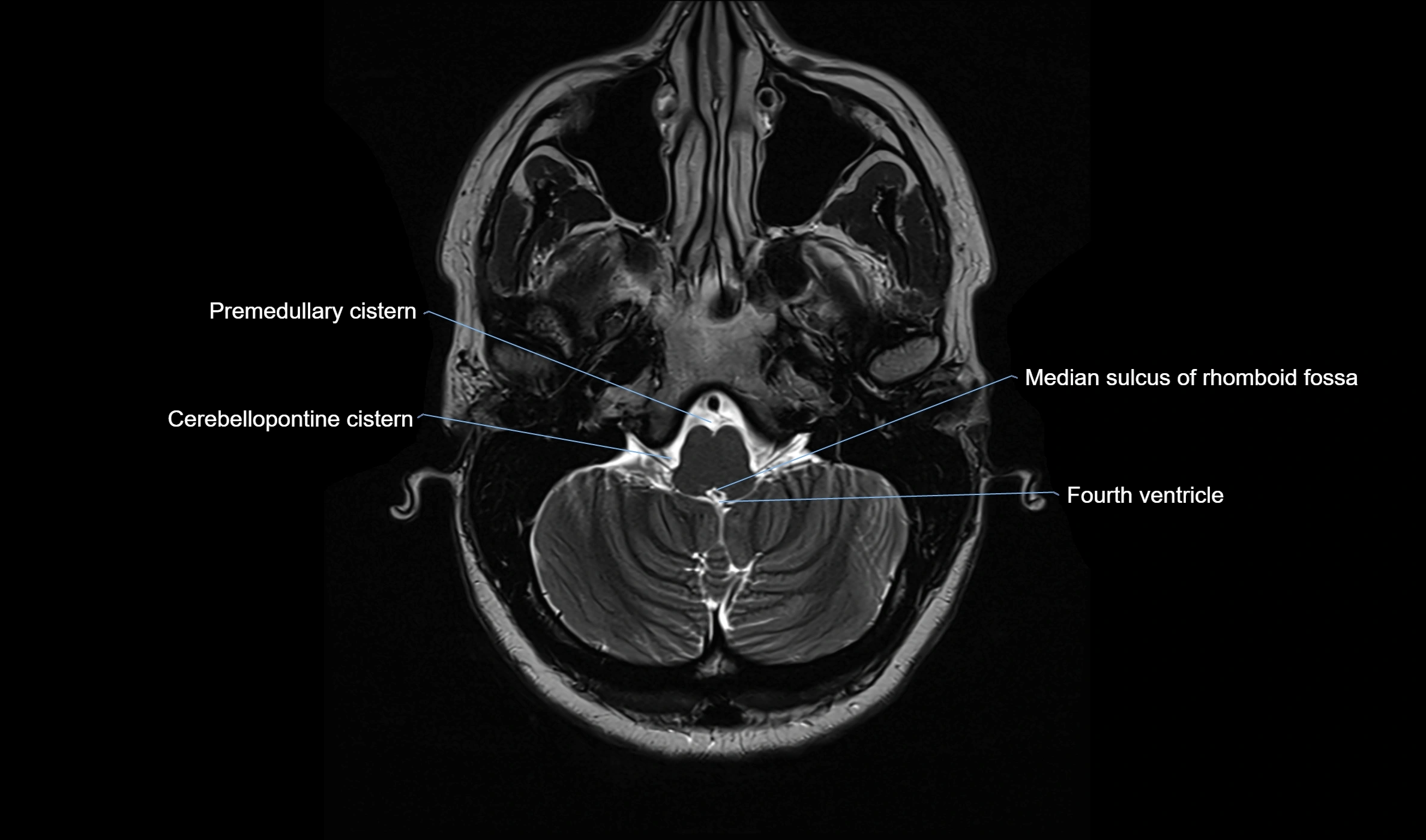 Brain cisterns  and ventricles  axial anatomy 3T MRI image-img-00001-00008.webp